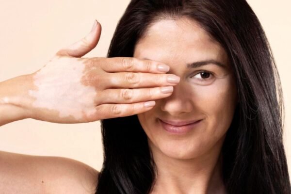 mujer con vitiligo