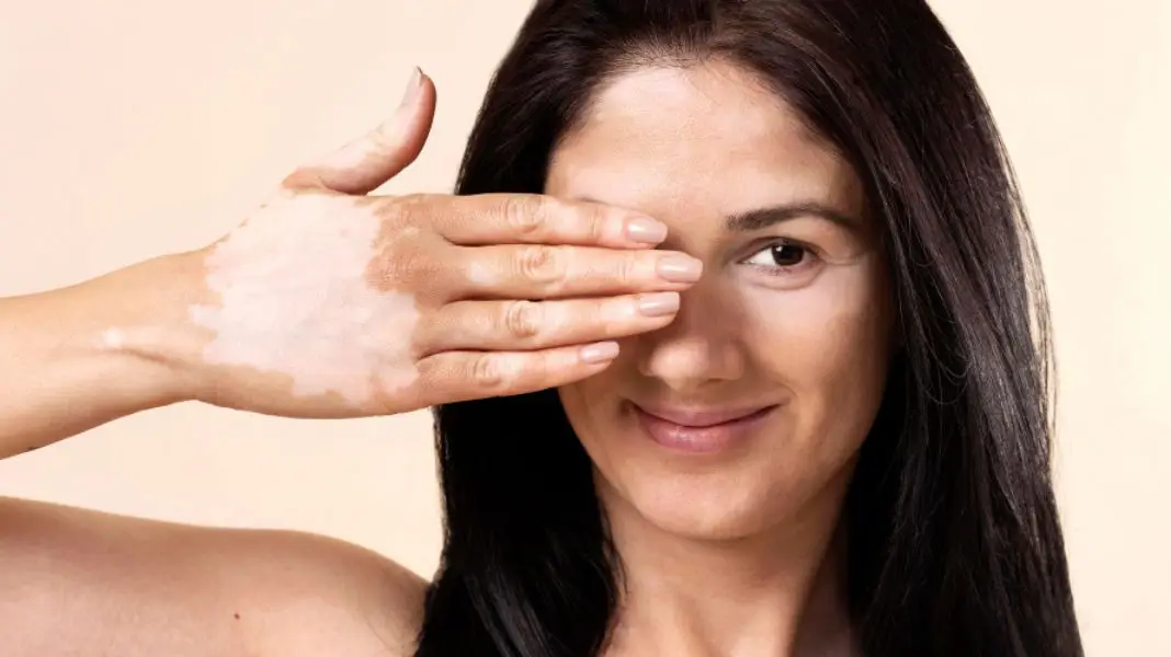 mujer con vitiligo