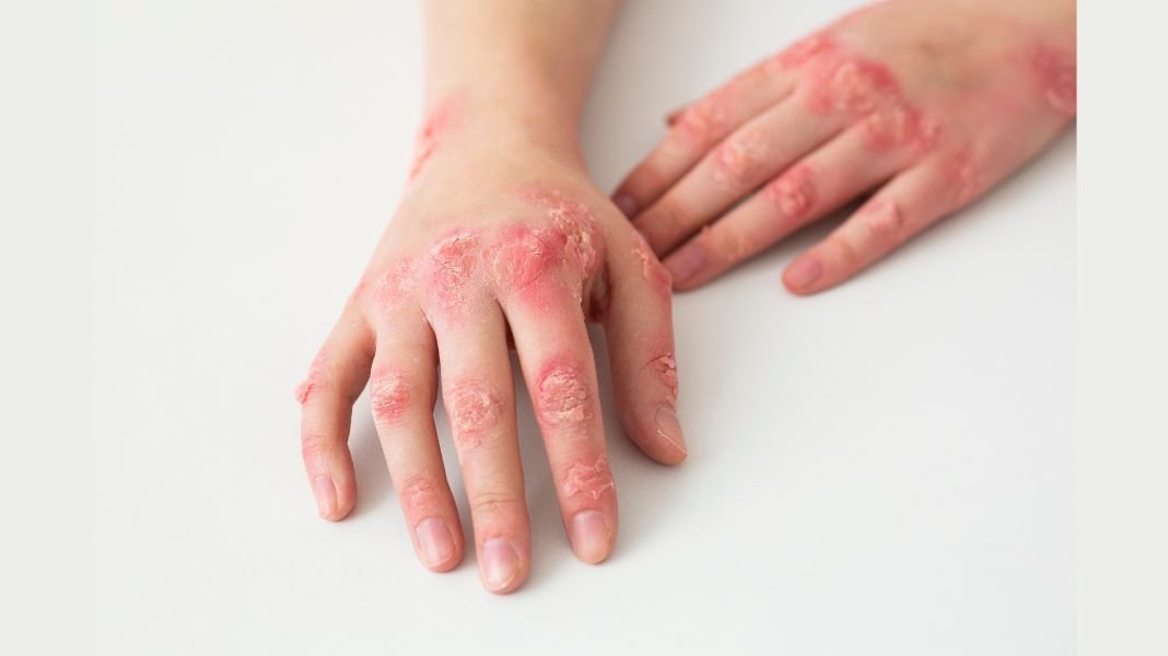 5 consejos para controlar los brotes y vivir con confianza