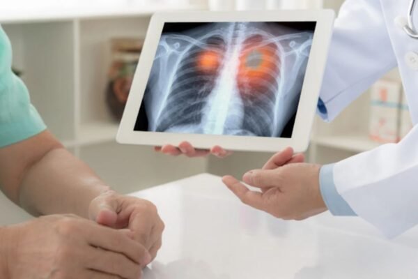 Mes de concientización sobre el cáncer del pulmón: cinco formas en las que el Perú está avanzando para combatir esta patología