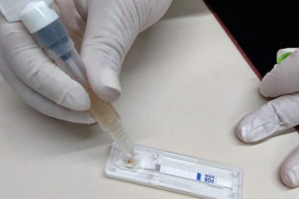 Minsa utiliza prueba FIT para tamizaje de detección oportuna de cáncer de colon y recto