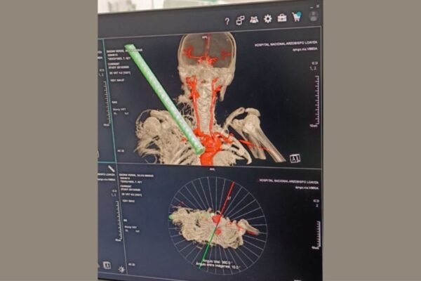 Minsa: médicos del Hospital Arzobispo Loayza extraen con éxito fierro incrustado en supraclavicular derecha de mujer de 42 años