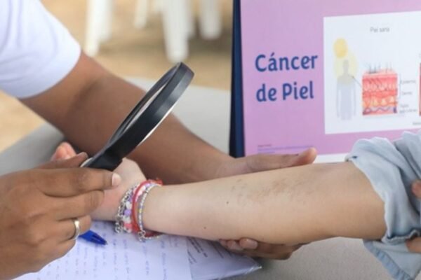 Atención viajeros: Minsa te brinda 5 recomendaciones para prevenir el cáncer a la piel este feriado de Semana Santa