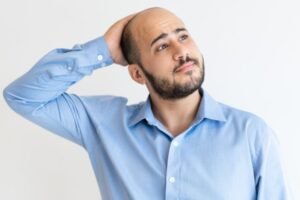Calvicie masculina: cinco recomendaciones ante las primeras señales