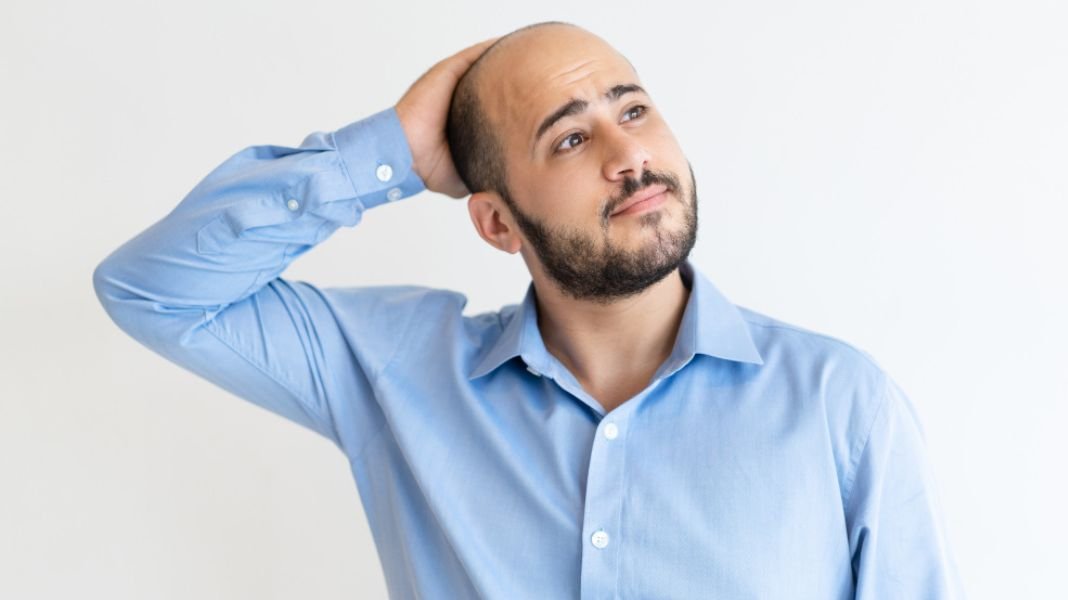 Calvicie masculina: cinco recomendaciones ante las primeras señales