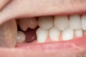 ¿Sabías que perder un solo diente puede envejecer el rostro hasta 10 años?