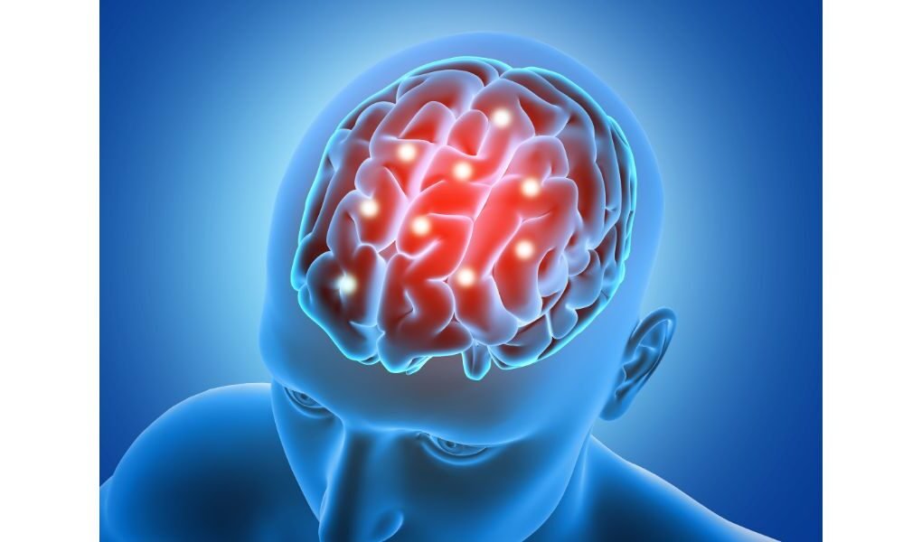 ACV o derrame cerebral: las señales de alerta que debes reconocer y cómo actuar a tiempo