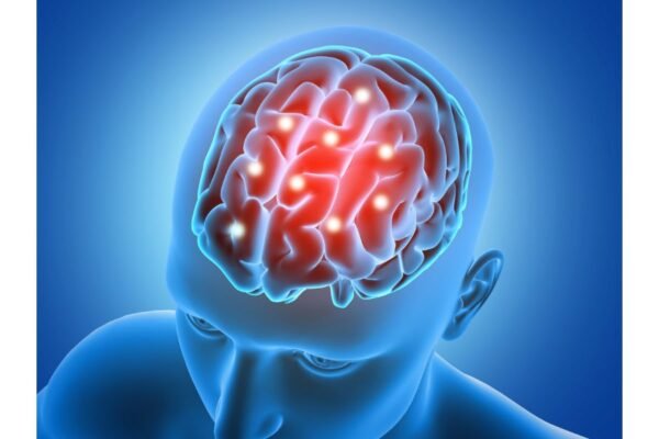 ACV o derrame cerebral: las señales de alerta que debes reconocer y cómo actuar a tiempo